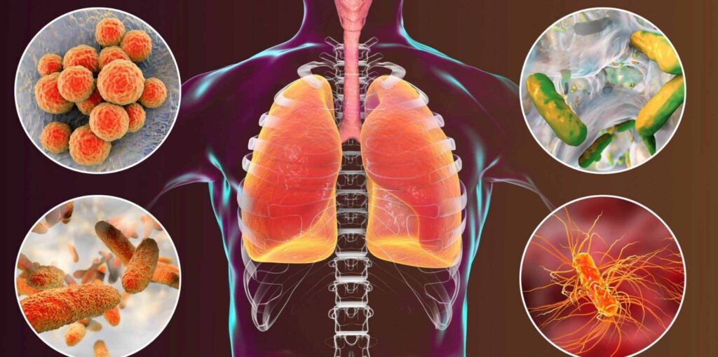 Pneumonia: Ce este, cum se manifestă și cum poate fi prevenită