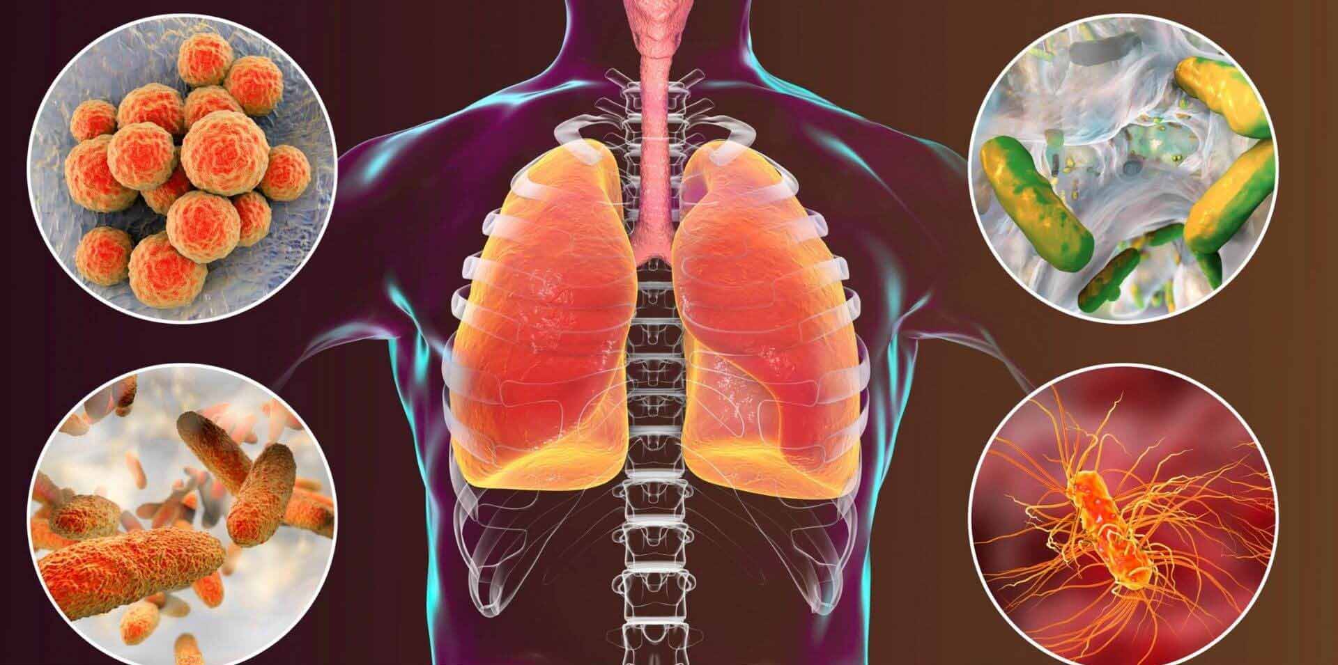 Pneumonia: Ce este, cum se manifestă și cum poate fi prevenită